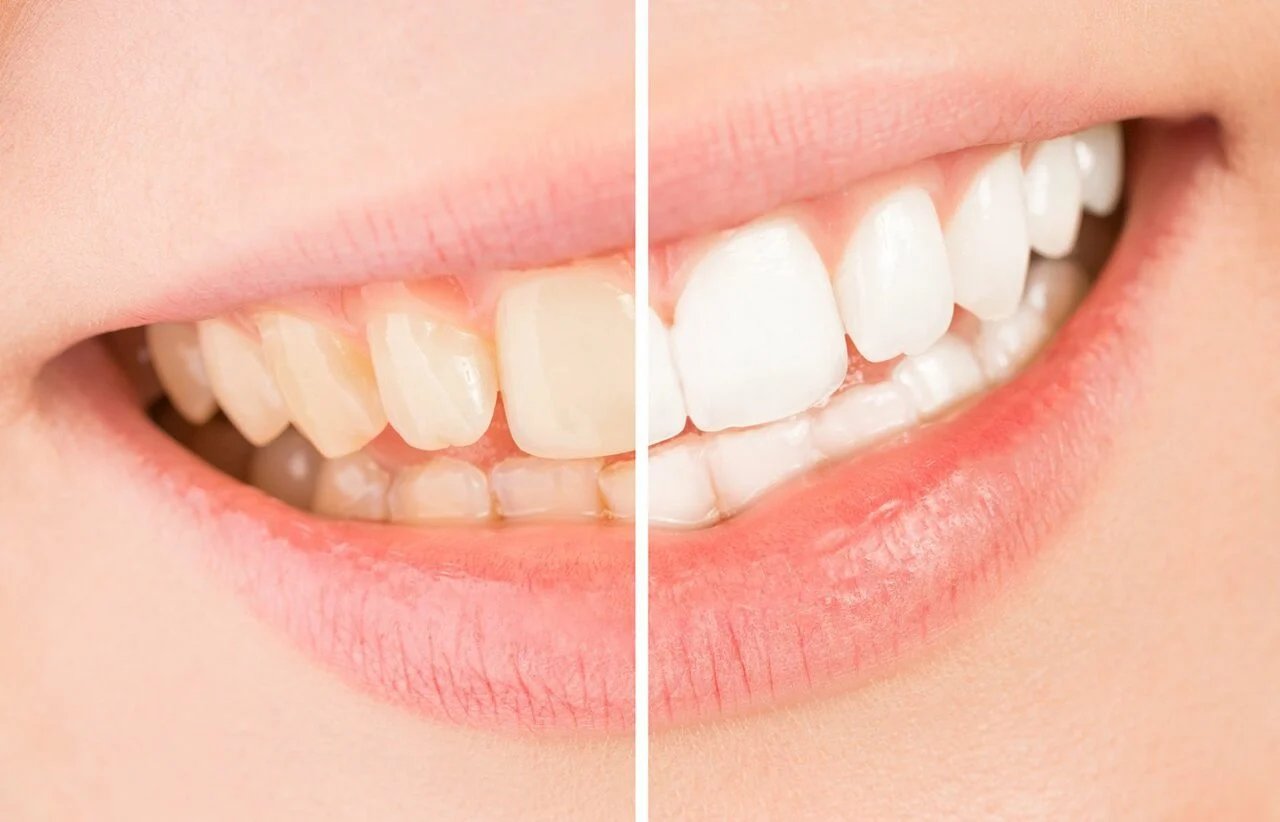 - - Tooth Whitening Result